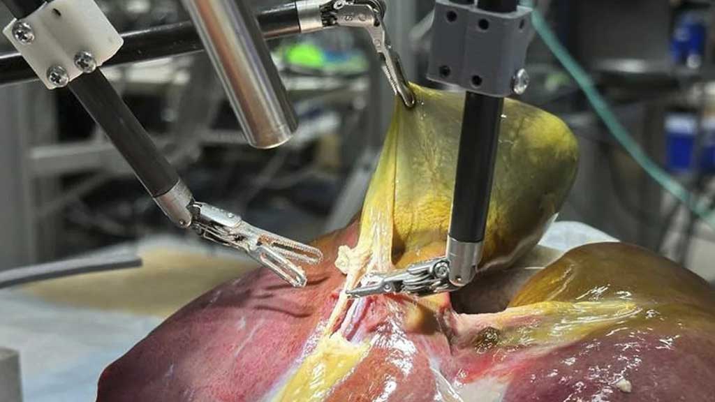মানব দেহে ‘সফল অস্ত্রোপচার’ রোবটের
